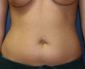 Feel Beautiful - Liposuction abdomen - Before Photo